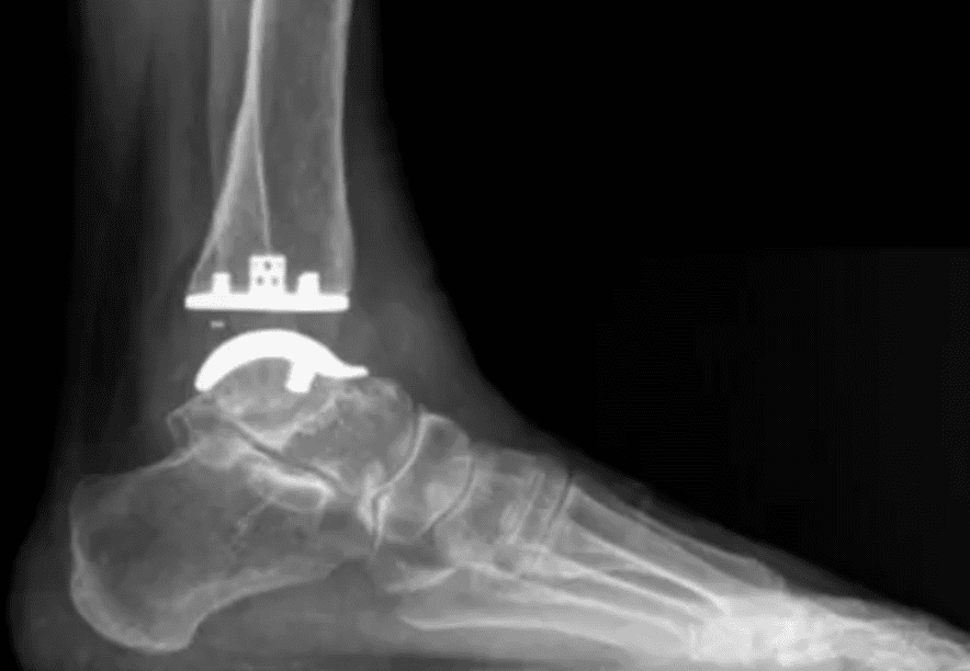 XRAY after an ankle replacement

